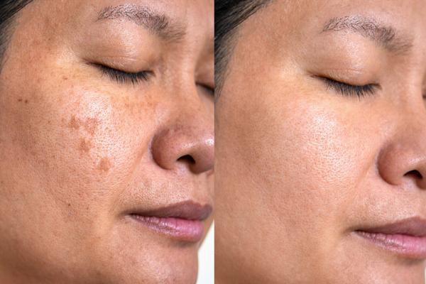 Woman before and after acne treatment