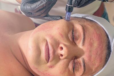Three microneedling treatments